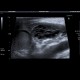 Inguinal hernia, laparoscopic repair, remained peritoneal sac with hematoma: US - Ultrasound